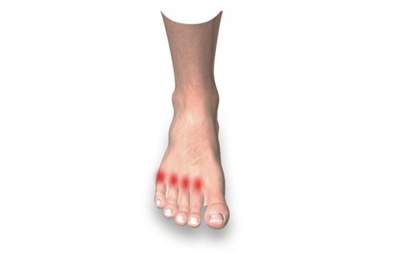 Illustration of foot with red area indicating pain caused by Metatarsalgia